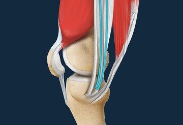 ACL Reconstruction