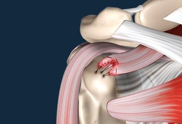 Rotator Cuff Repair